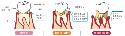 歯周病の進行